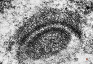 M,12y. | intracytoplasmic desmosome - pineal germinoma M,12y. | intracytoplasmic desmosome - pineal germinoma